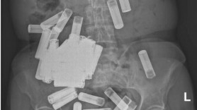 Descoperire șocantă în intestinul și stomacul unei femei. Reacția medicilor
